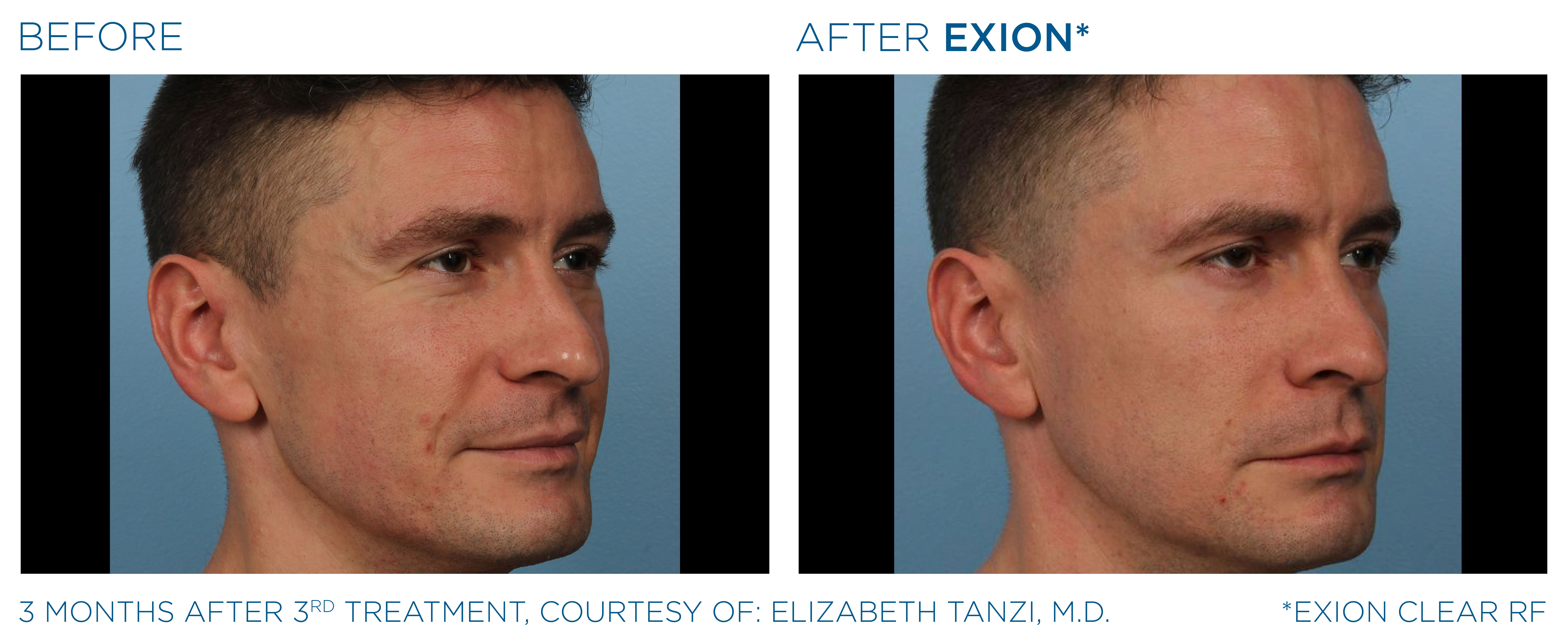 EXION Clear RF before and after — male face
