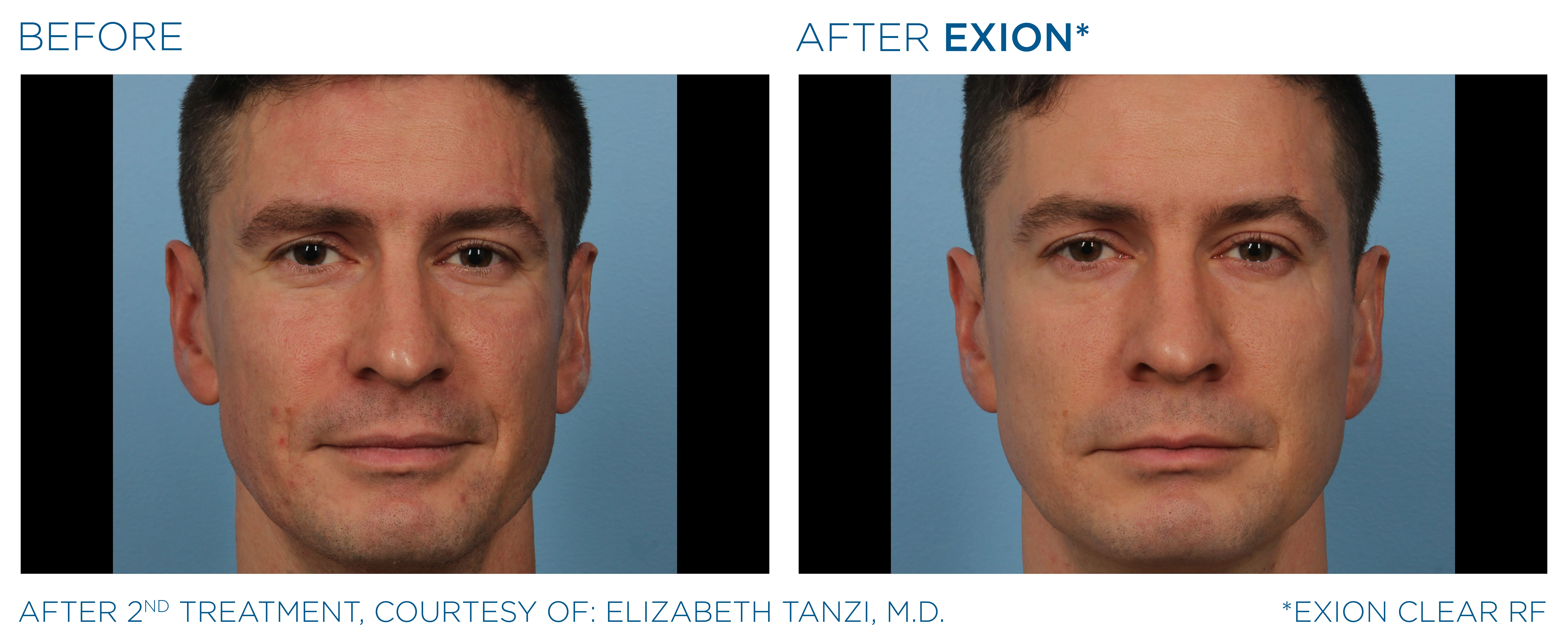 EXION Clear RF before and after — male face, refined results