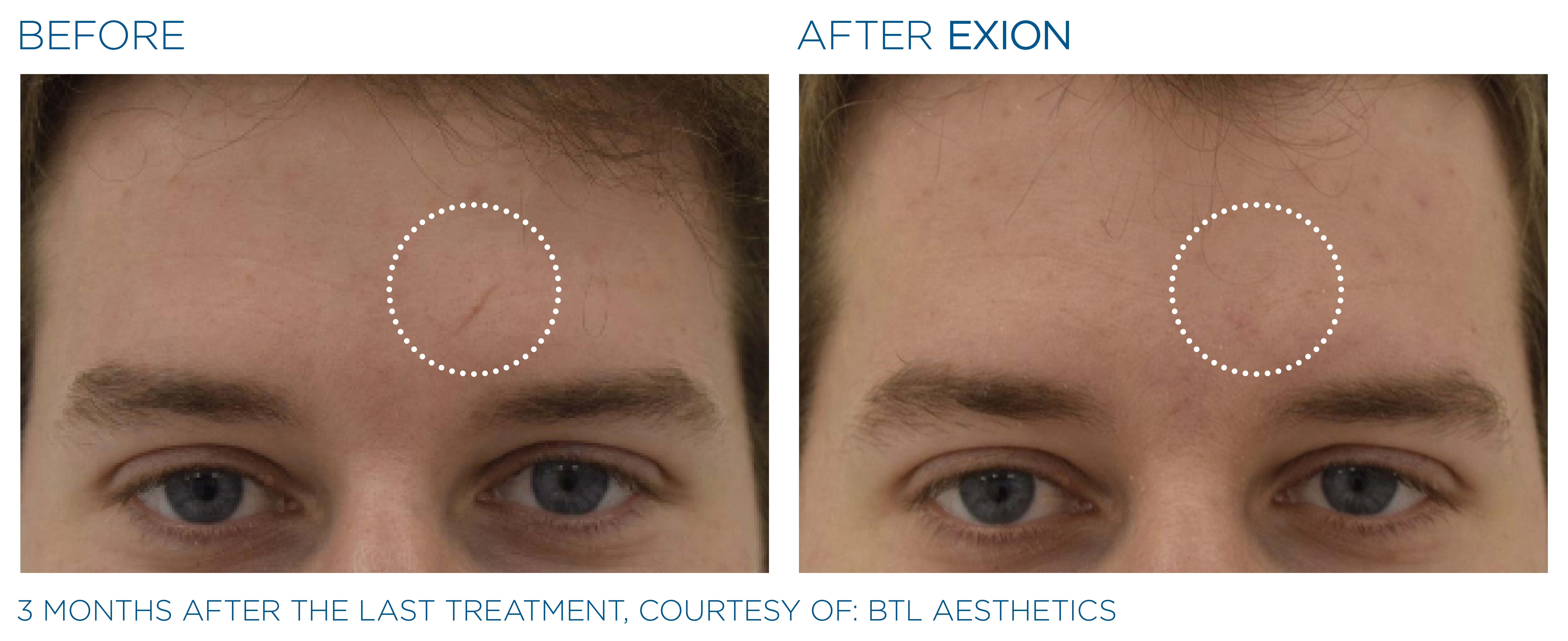 EXION before and after — male forehead, clearer smoother skin
